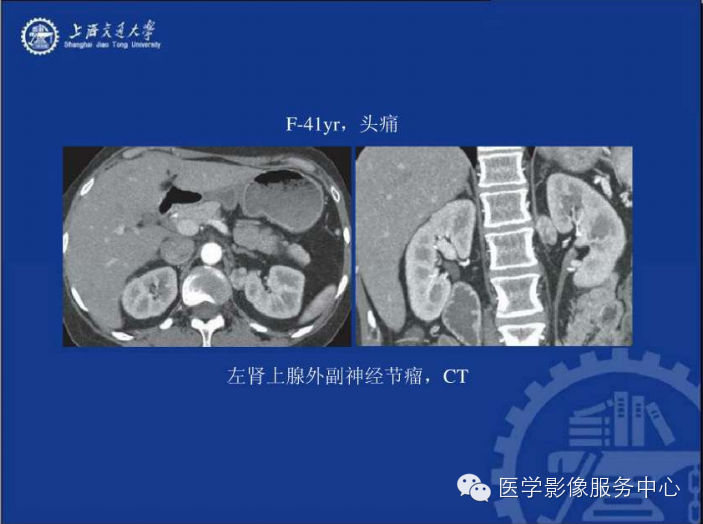 腹膜后间隙病变的影像诊断