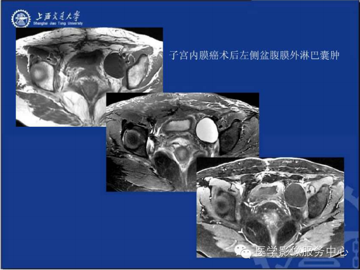 腹膜后间隙病变的影像诊断