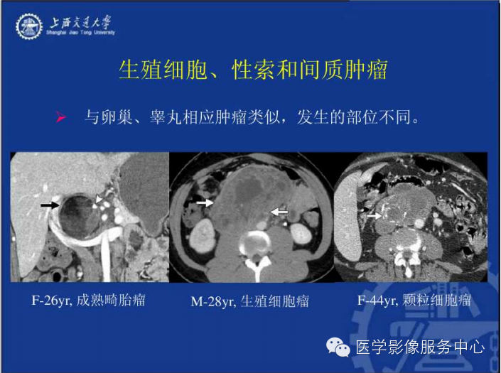 腹膜后间隙病变的影像诊断