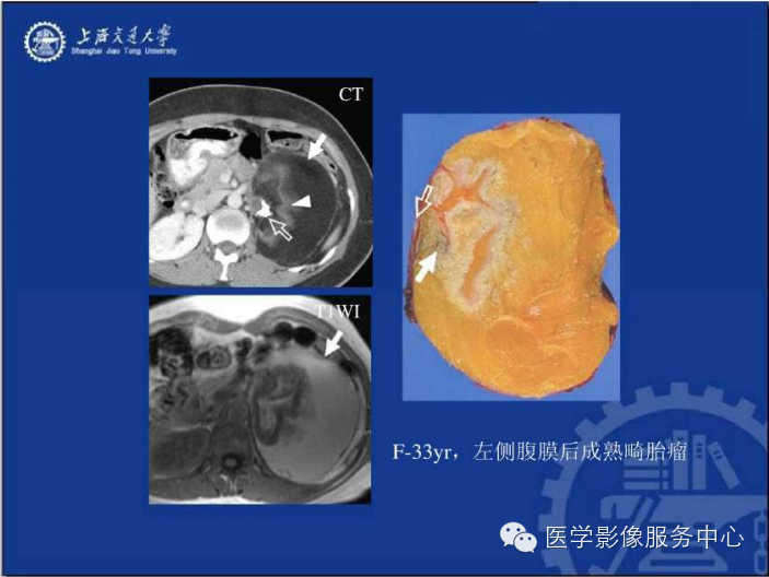 腹膜后间隙病变的影像诊断