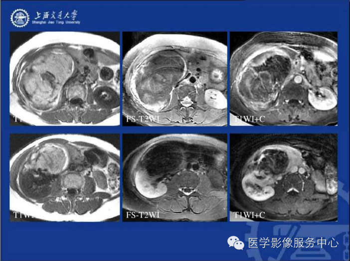 腹膜后间隙病变的影像诊断