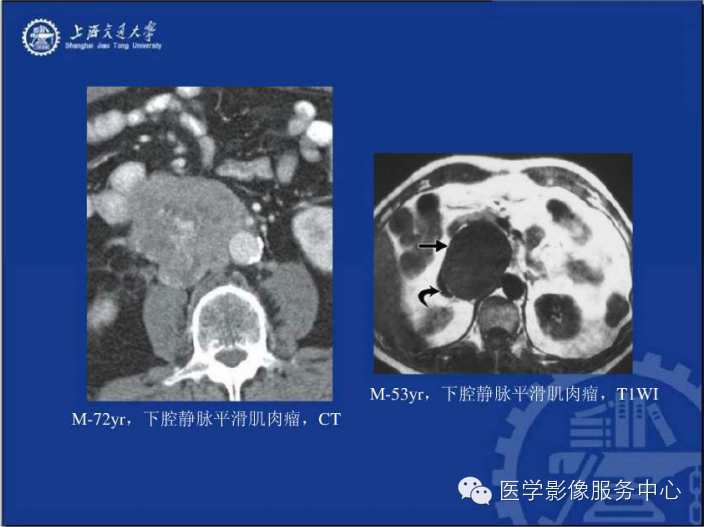 腹膜后间隙病变的影像诊断