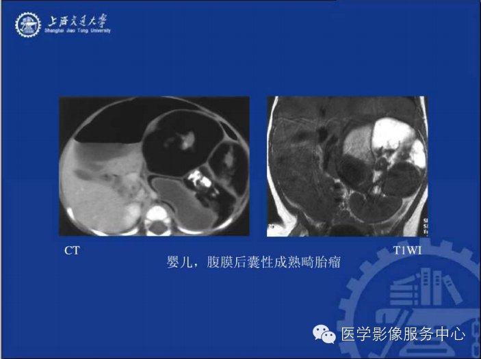 腹膜后间隙病变的影像诊断