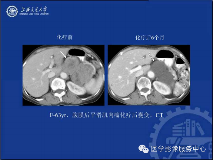 腹膜后间隙病变的影像诊断