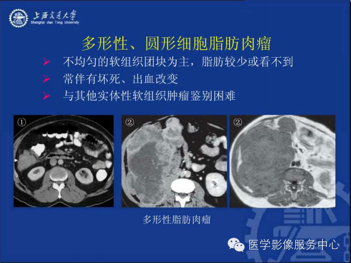 腹膜后间隙病变的影像诊断