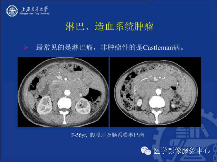 腹膜后间隙病变的影像诊断