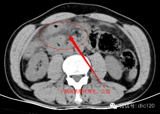 造成肠系膜混浊征的主要疾病鉴别 造成肠系膜混浊征的主要疾病鉴别