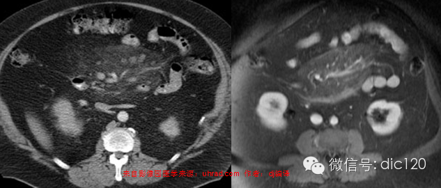 造成肠系膜混浊征的主要疾病鉴别 造成肠系膜混浊征的主要疾病鉴别