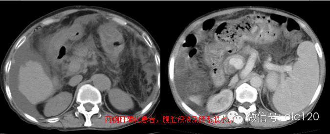造成肠系膜混浊征的主要疾病鉴别