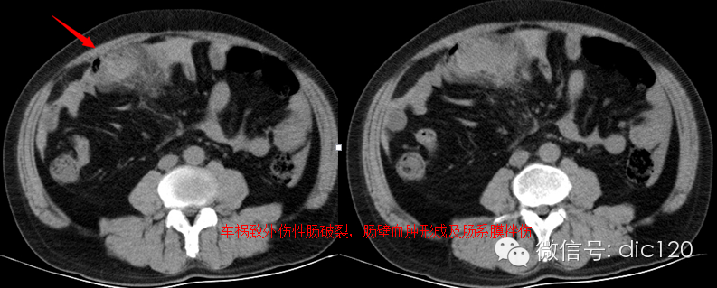 造成肠系膜混浊征的主要疾病鉴别 造成肠系膜混浊征的主要疾病鉴别