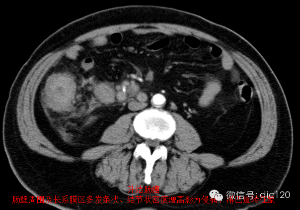 造成肠系膜混浊征的主要疾病鉴别 造成肠系膜混浊征的主要疾病鉴别