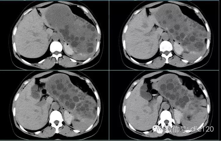 【典型病例】肝脏、脾脏、腹腔包虫病一例