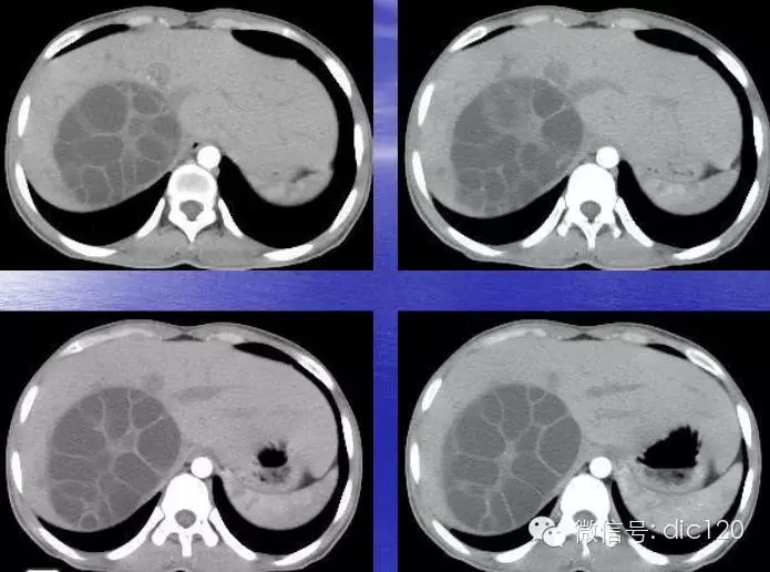 【典型病例】肝脏、脾脏、腹腔包虫病一例