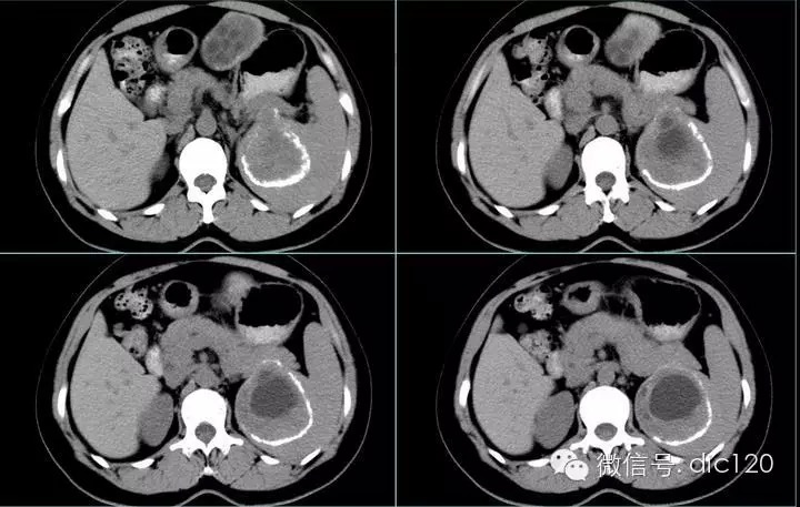 【典型病例】肝脏、脾脏、腹腔包虫病一例