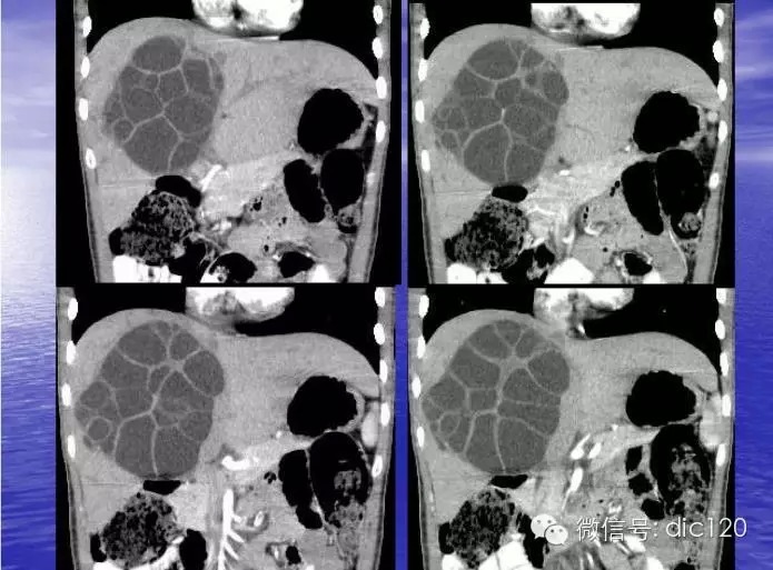 【典型病例】肝脏、脾脏、腹腔包虫病一例