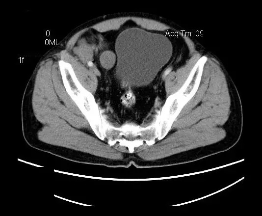 【病例】盆腔神经鞘瘤一例