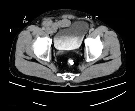 【病例】盆腔神经鞘瘤一例