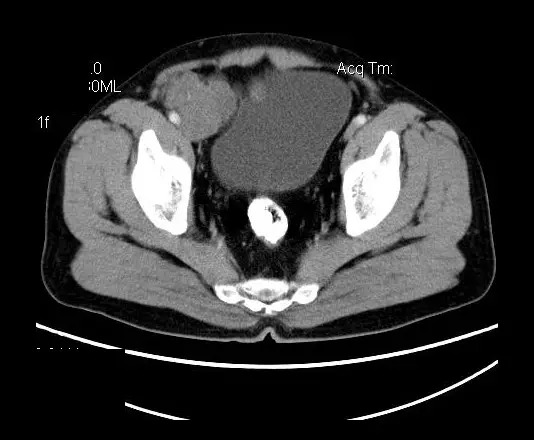 【病例】盆腔神经鞘瘤一例
