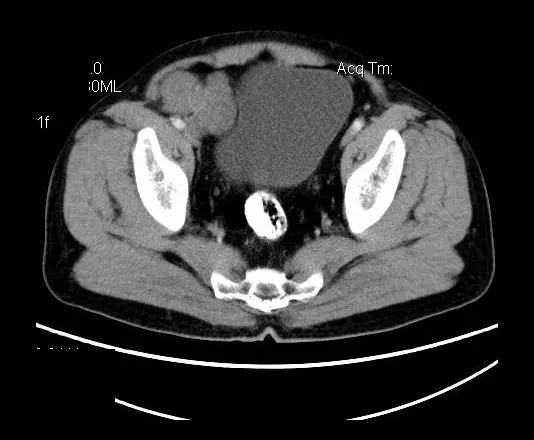 【病例】盆腔神经鞘瘤一例