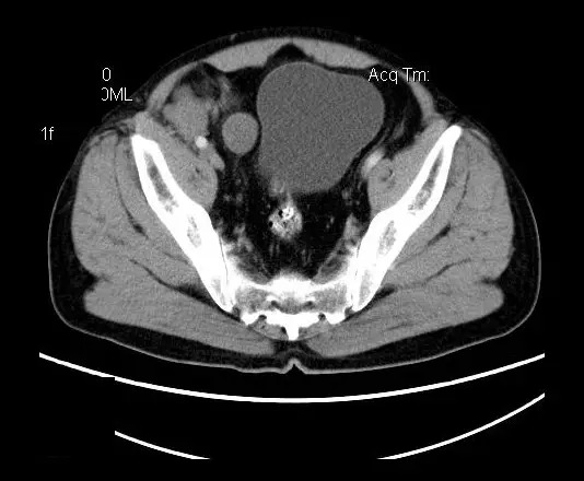 【病例】盆腔神经鞘瘤一例
