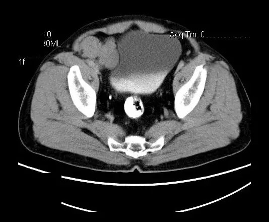 【病例】盆腔神经鞘瘤一例