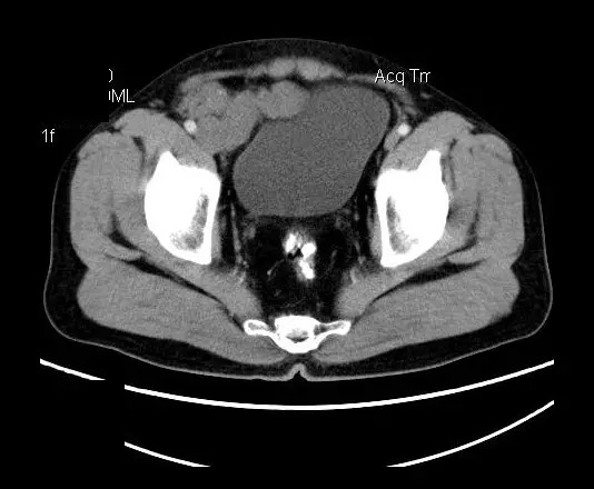 【病例】盆腔神经鞘瘤一例