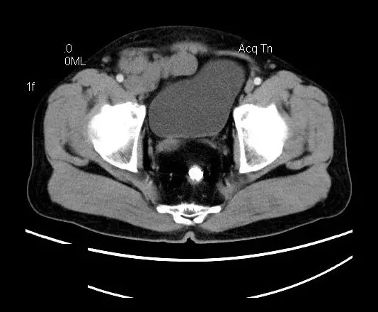 【病例】盆腔神经鞘瘤一例