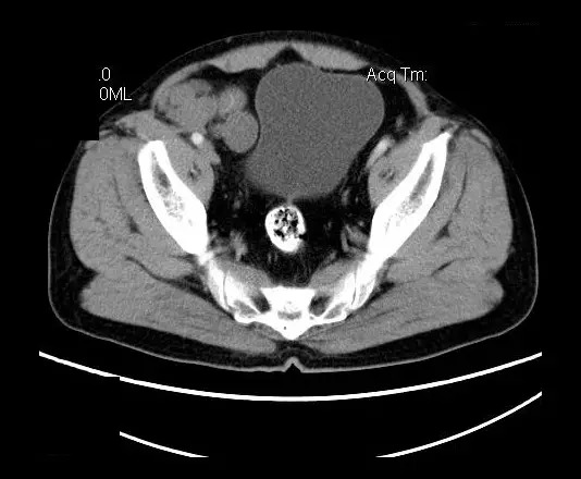 【病例】盆腔神经鞘瘤一例
