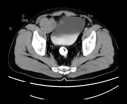 【病例】盆腔神经鞘瘤一例