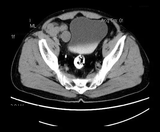 【病例】盆腔神经鞘瘤一例