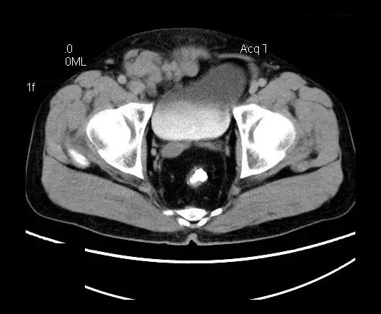 【病例】盆腔神经鞘瘤一例