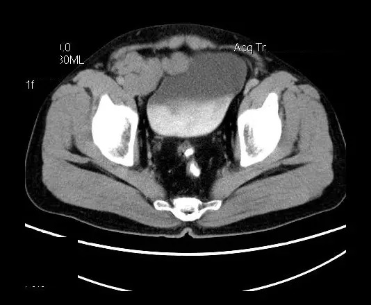 【病例】盆腔神经鞘瘤一例