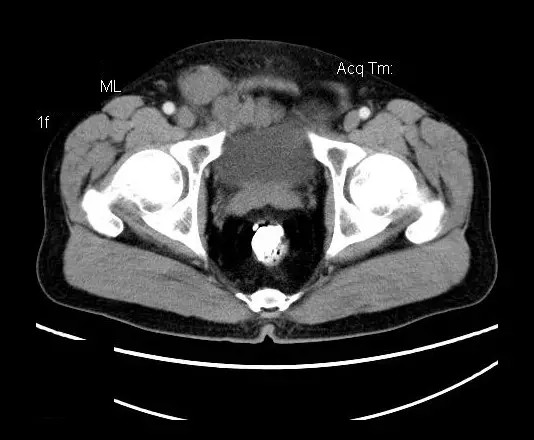【病例】盆腔神经鞘瘤一例