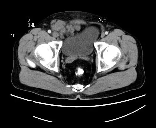 【病例】盆腔神经鞘瘤一例