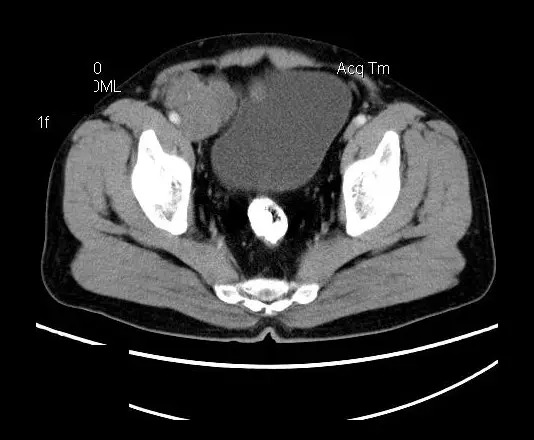 【病例】盆腔神经鞘瘤一例