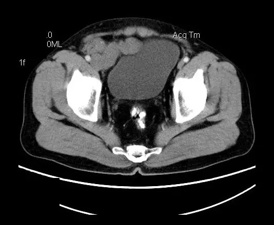 【病例】盆腔神经鞘瘤一例