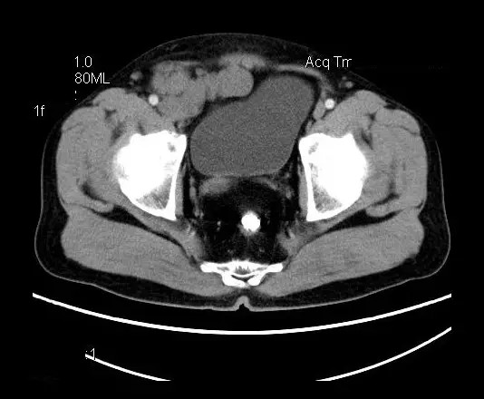 【病例】盆腔神经鞘瘤一例