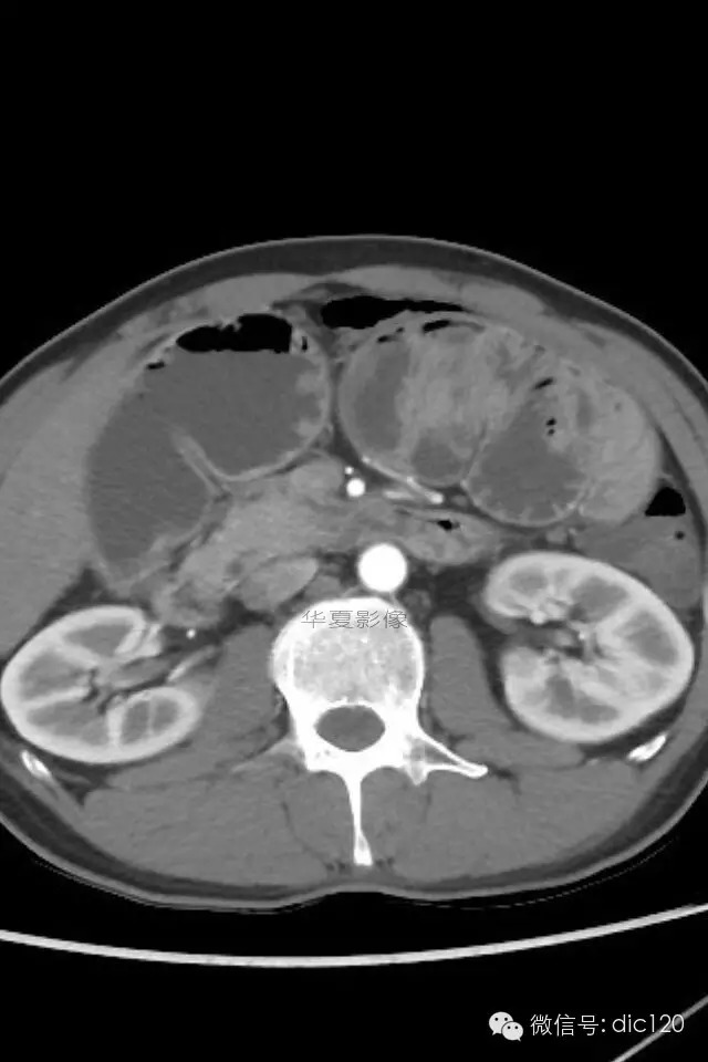 【典型病例】小肠禁锢症