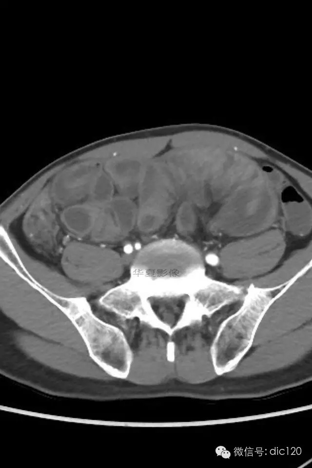 【典型病例】小肠禁锢症