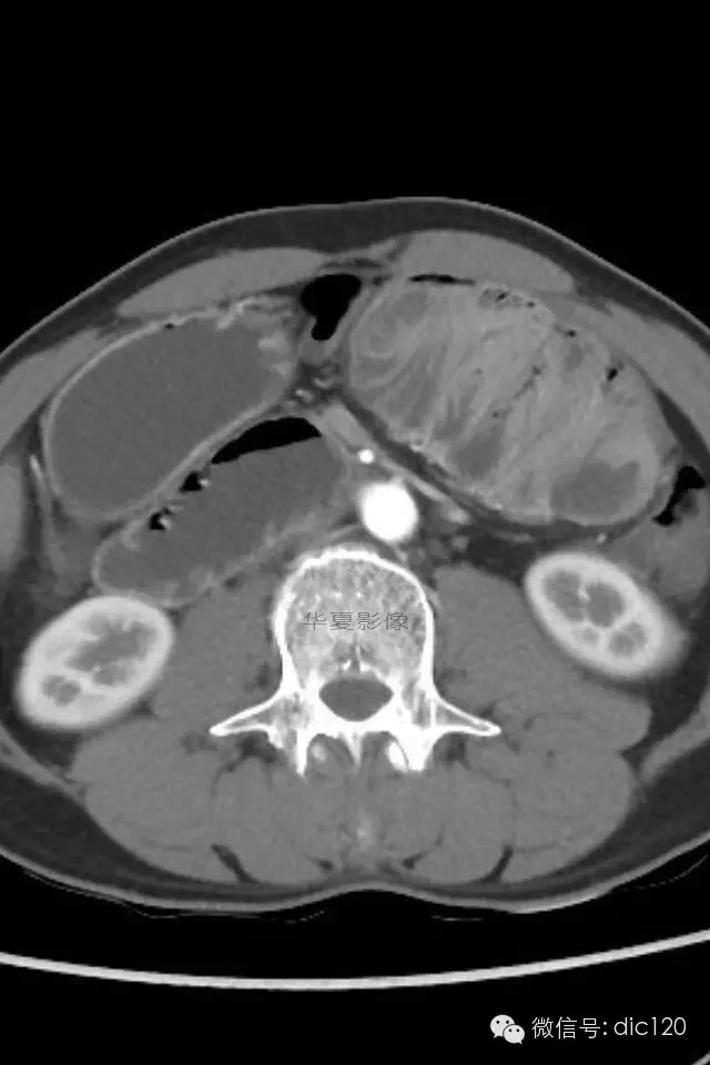 【典型病例】小肠禁锢症