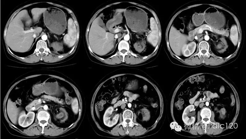 【病例及解析】黄色肉芽肿型肾盂肾炎CT影像表现