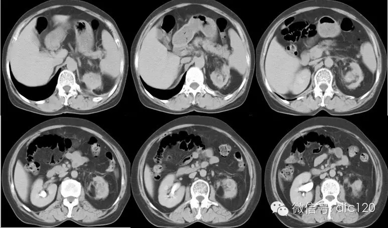 【病例及解析】黄色肉芽肿型肾盂肾炎CT影像表现