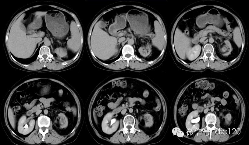 【病例及解析】黄色肉芽肿型肾盂肾炎CT影像表现