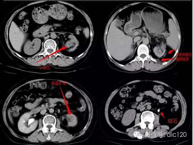 【病例及解析】黄色肉芽肿型肾盂肾炎CT影像表现