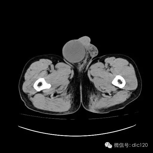 【病例】右侧睾丸精原细胞瘤一例 【病例】右侧睾丸精原细胞瘤一例