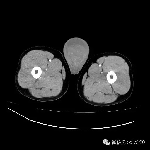 【病例】右侧睾丸精原细胞瘤一例 【病例】右侧睾丸精原细胞瘤一例
