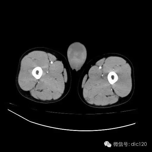 【病例】右侧睾丸精原细胞瘤一例 【病例】右侧睾丸精原细胞瘤一例