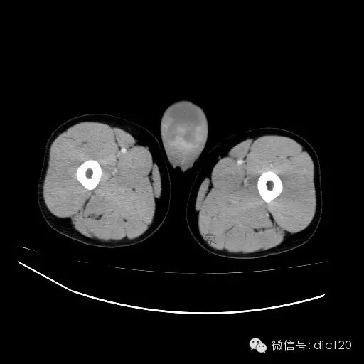 【病例】右侧睾丸精原细胞瘤一例 【病例】右侧睾丸精原细胞瘤一例