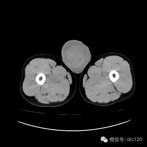 【病例】右侧睾丸精原细胞瘤一例 【病例】右侧睾丸精原细胞瘤一例