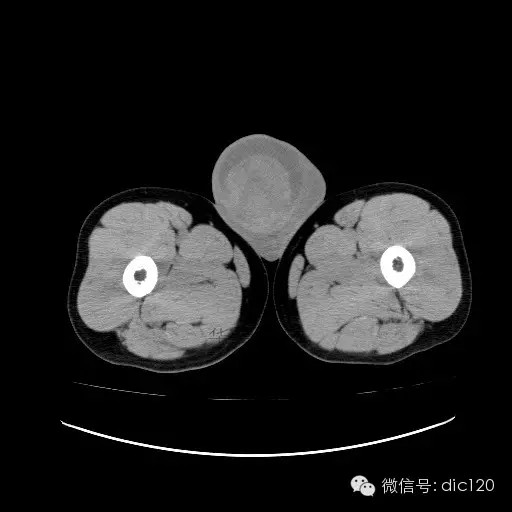 【病例】右侧睾丸精原细胞瘤一例 【病例】右侧睾丸精原细胞瘤一例